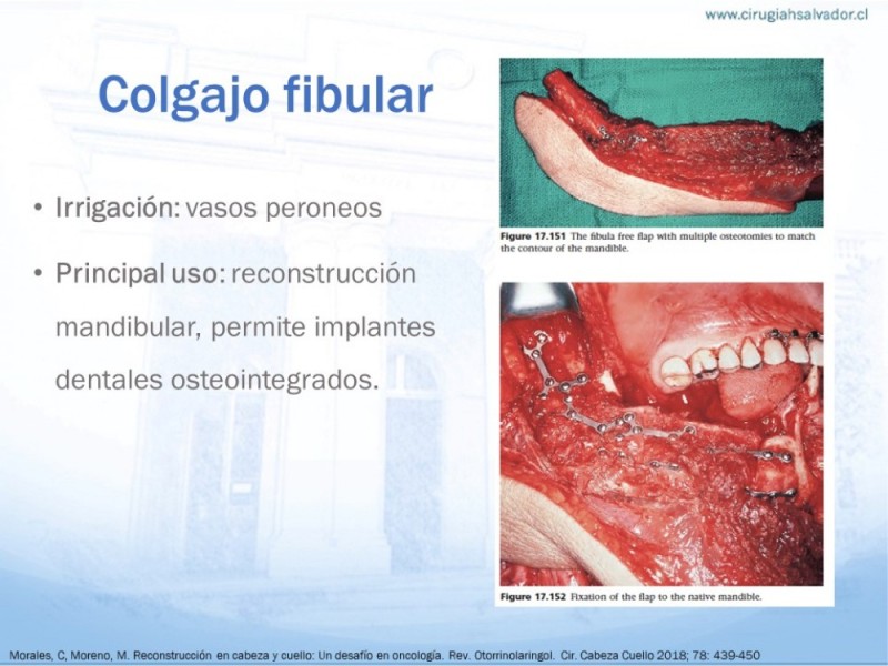 Diapositiva 18 de Colgajos MicroquirúrgicosColgajos Microquirúrgicos