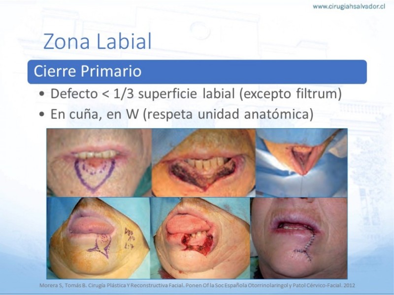 Diapositiva 36 de Tipos de Reconstrucción Facial