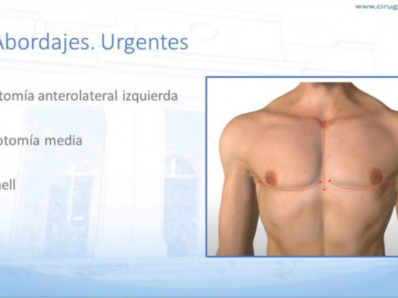 Diapositiva 17 de Trauma penetrante cardíaco