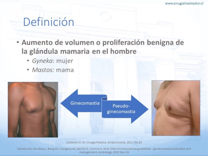 Diapositiva 1 de Ginecomastia