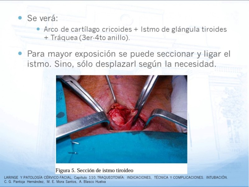Diapositiva 16 de Traqueotomía: Indicaciones y técnica