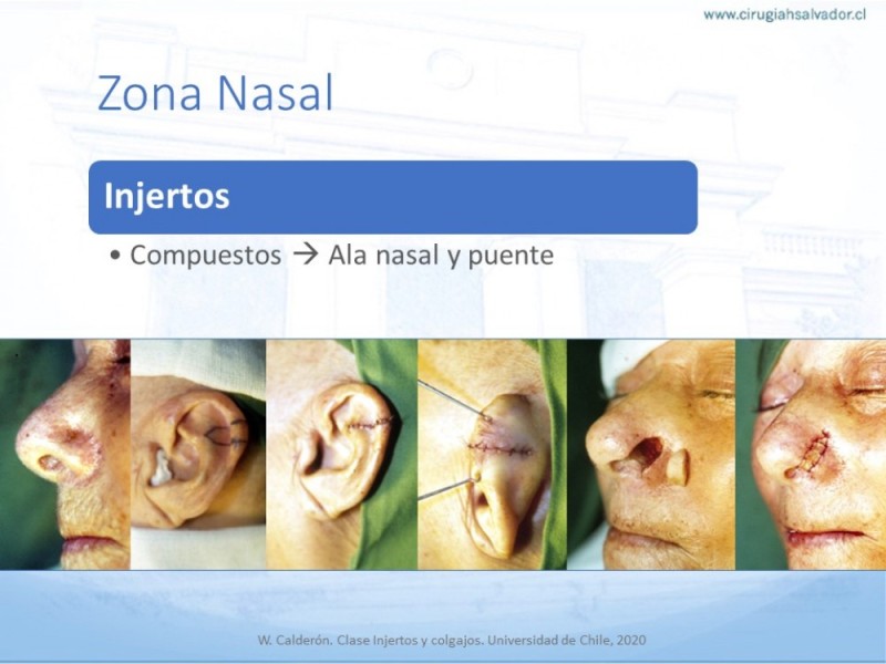 Diapositiva 28 de Tipos de Reconstrucción Facial