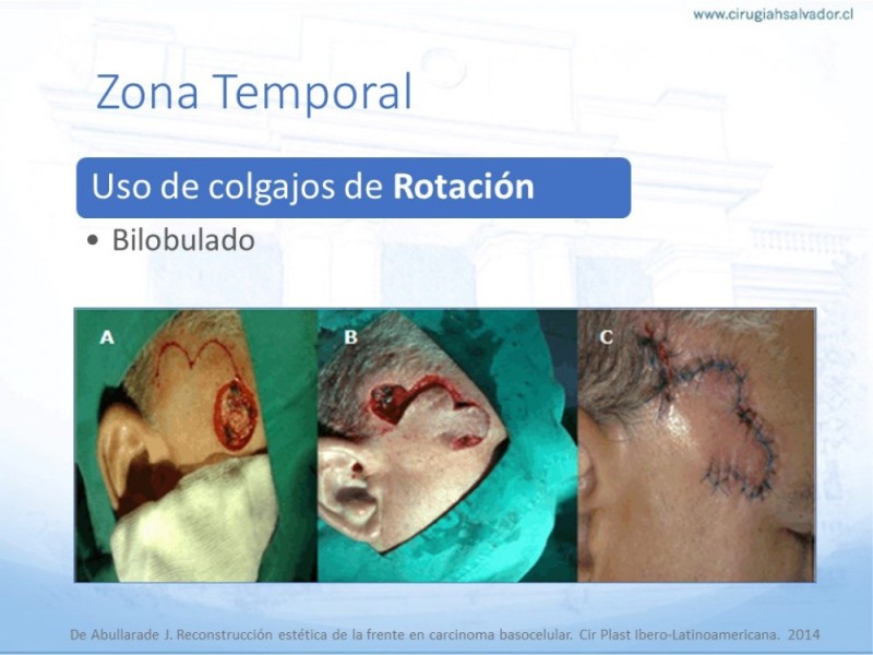 Diapositiva 21 de Tipos de Reconstrucción Facial
