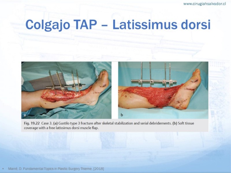 Diapositiva 15 de Colgajos MicroquirúrgicosColgajos Microquirúrgicos