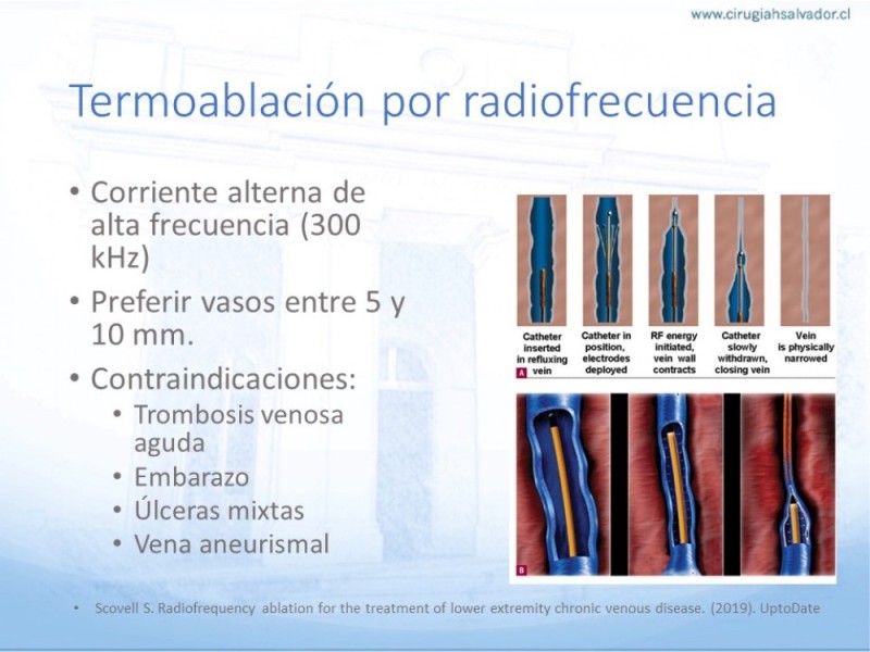 Diapositiva 19 de Safenectomía: Técnica y resultados a largo plazo