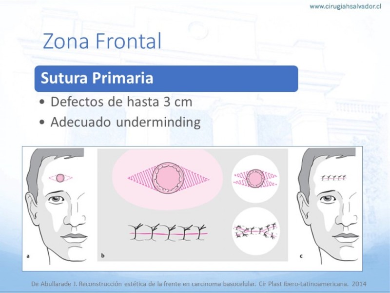 Diapositiva 16 de Tipos de Reconstrucción Facial