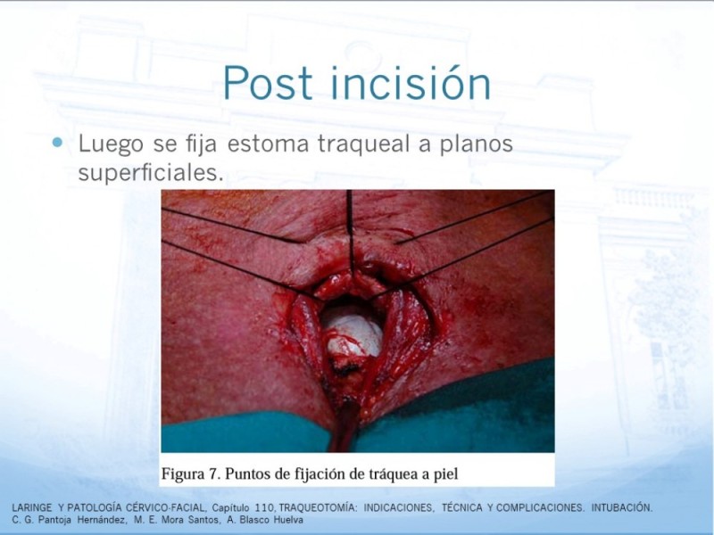Diapositiva 21 de Traqueotomía: Indicaciones y técnica