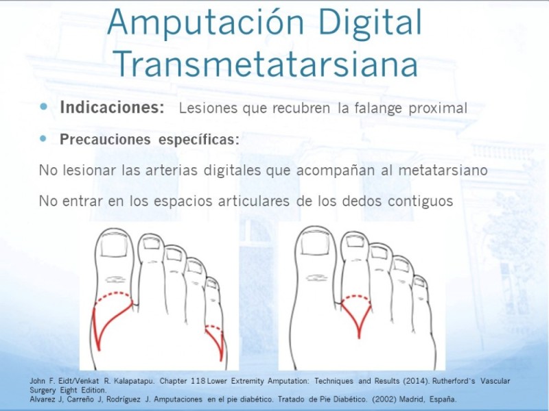 Diapositiva 6 de Técnica Quirúrgica Amputaciones Menores