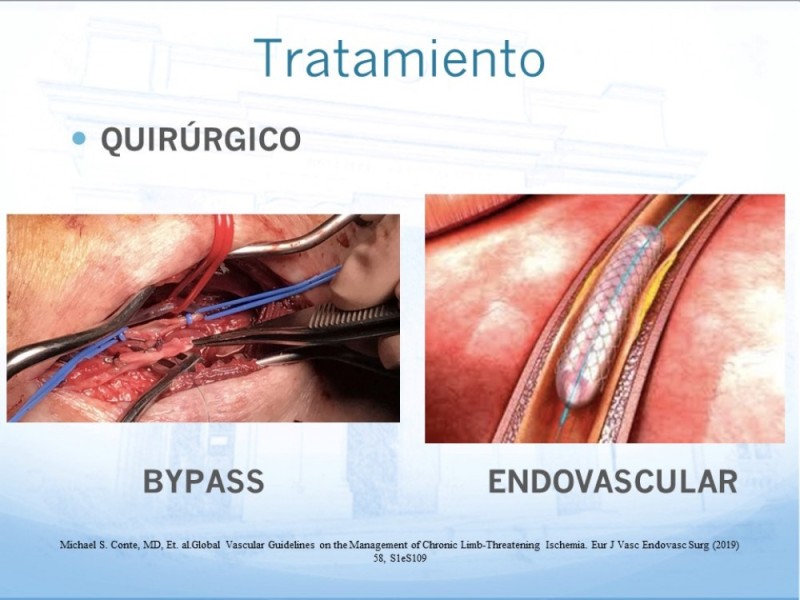 Diapositiva 11 de Tratamiento Endovascular de EAO Femoro-Distal