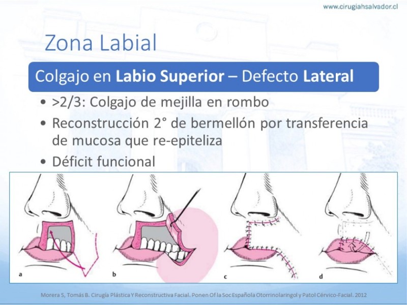 Diapositiva 40 de Tipos de Reconstrucción Facial