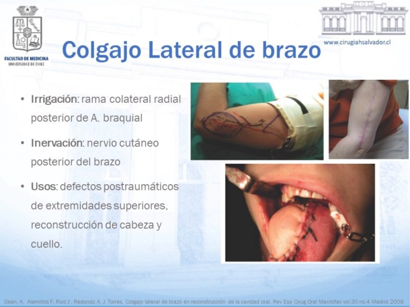 Diapositiva 19 de Colgajos MicroquirúrgicosColgajos Microquirúrgicos