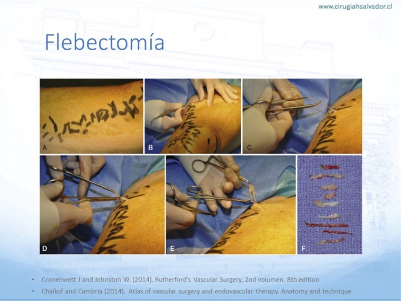 Diapositiva 12 de Safenectomía: Técnica y resultados a largo plazo