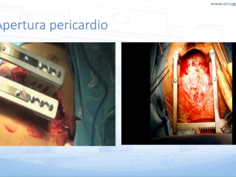 Diapositiva 20 de Trauma penetrante cardíaco