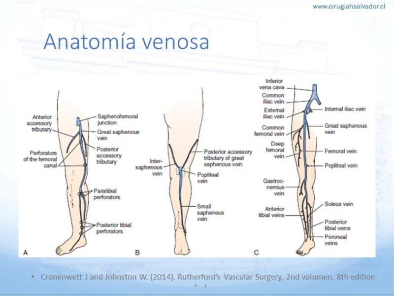 Diapositiva 4 de Safenectomía: Técnica y resultados a largo plazo