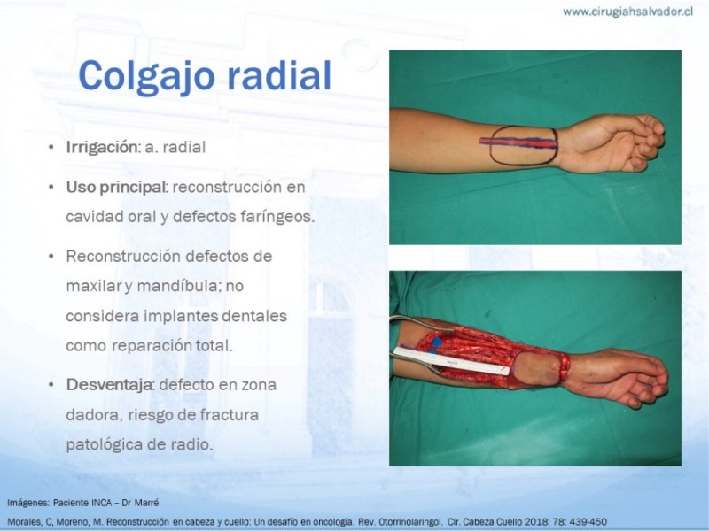 Diapositiva 16 de Colgajos MicroquirúrgicosColgajos Microquirúrgicos