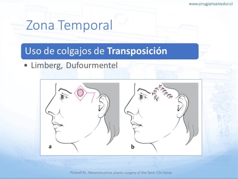 Diapositiva 22 de Tipos de Reconstrucción Facial