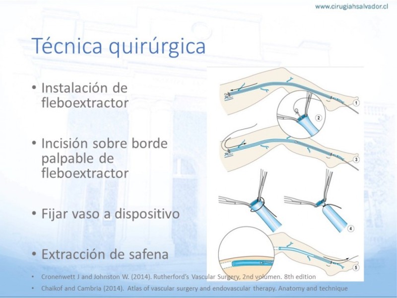 Diapositiva 11 de Safenectomía: Técnica y resultados a largo plazo