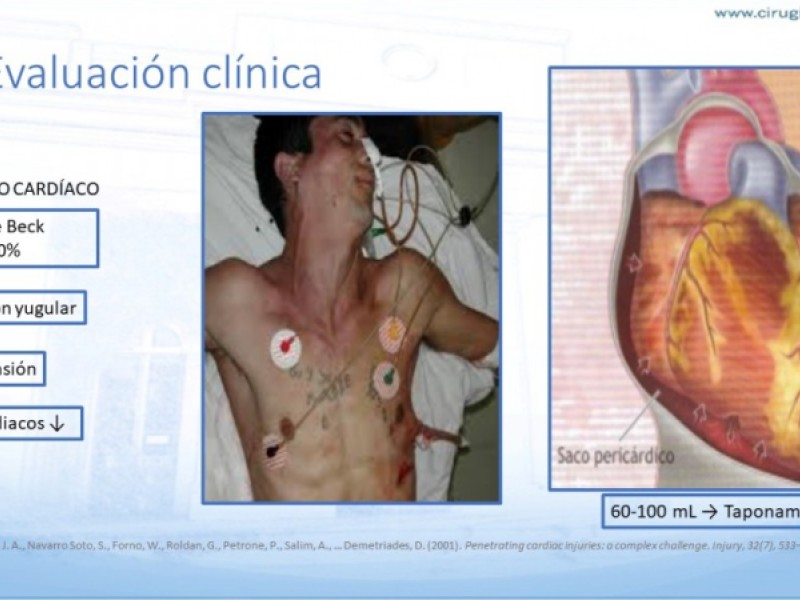 Diapositiva 10 de Trauma penetrante cardíaco