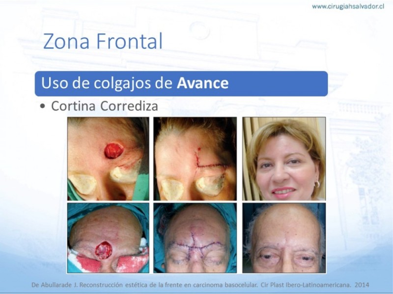 Diapositiva 20 de Tipos de Reconstrucción Facial