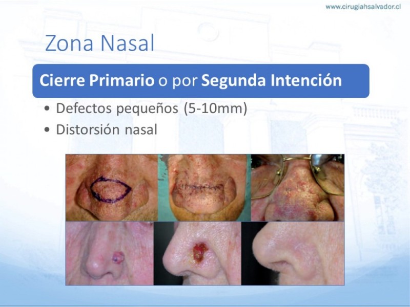 Diapositiva 26 de Tipos de Reconstrucción Facial