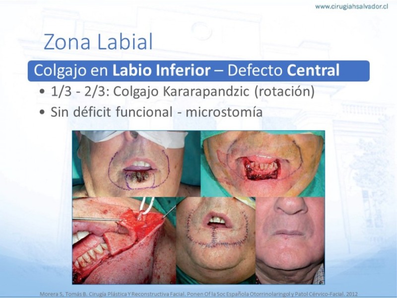 Diapositiva 41 de Tipos de Reconstrucción Facial