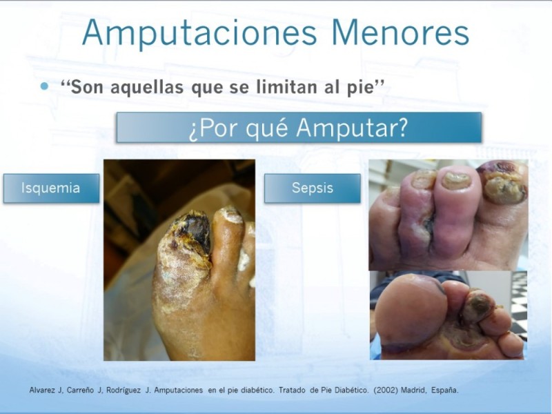 Diapositiva 3 de Técnica Quirúrgica Amputaciones Menores