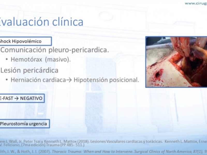 Diapositiva 11 de Trauma penetrante cardíaco