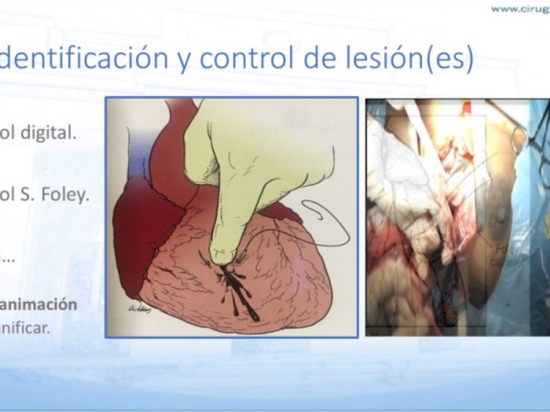 Diapositiva 21 de Trauma penetrante cardíaco