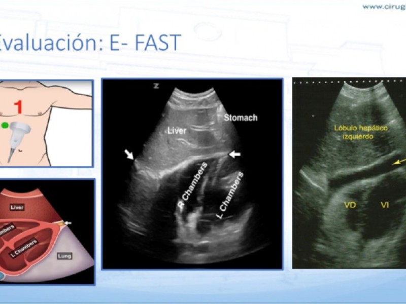 Diapositiva 12 de Trauma penetrante cardíaco