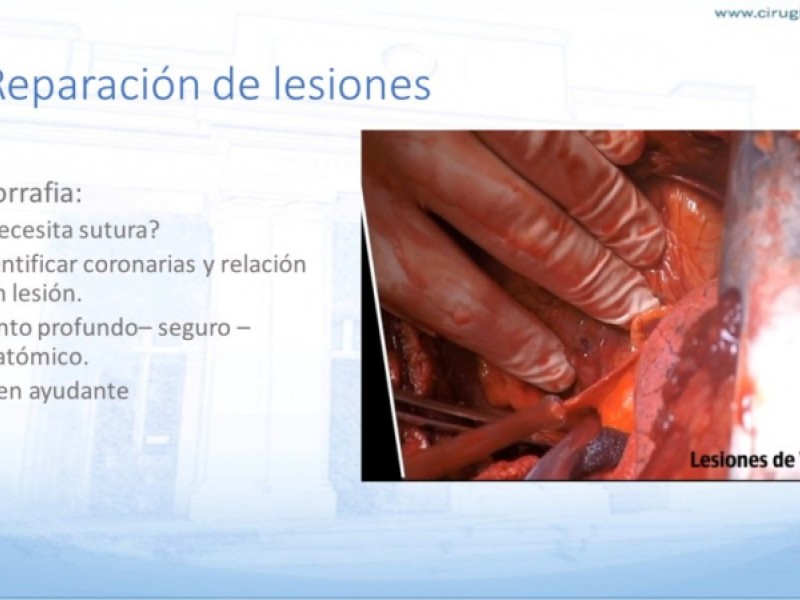 Diapositiva 22 de Trauma penetrante cardíaco