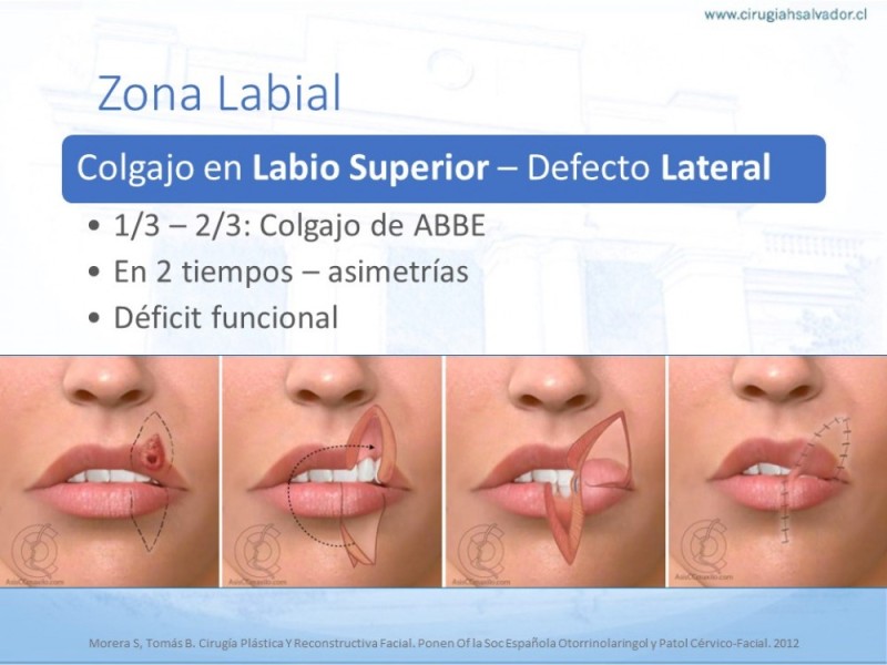Diapositiva 39 de Tipos de Reconstrucción Facial