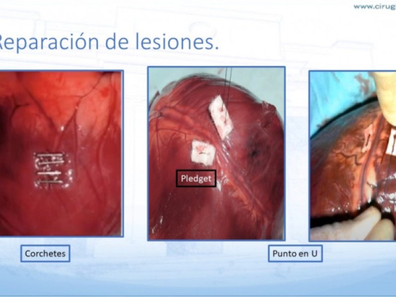 Diapositiva 24 de Trauma penetrante cardíaco