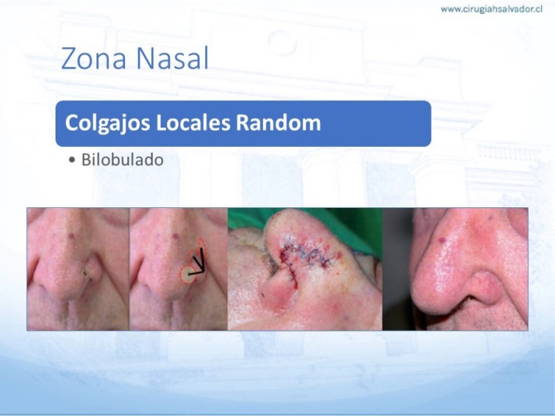 Diapositiva 29 de Tipos de Reconstrucción Facial