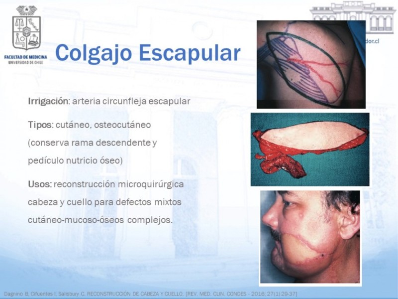 Diapositiva 20 de Colgajos MicroquirúrgicosColgajos Microquirúrgicos