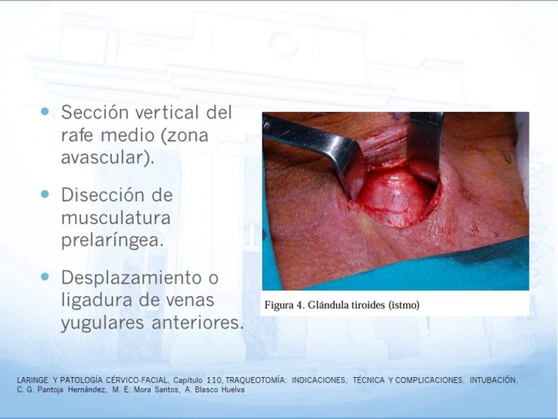 Diapositiva 15 de Traqueotomía: Indicaciones y técnica