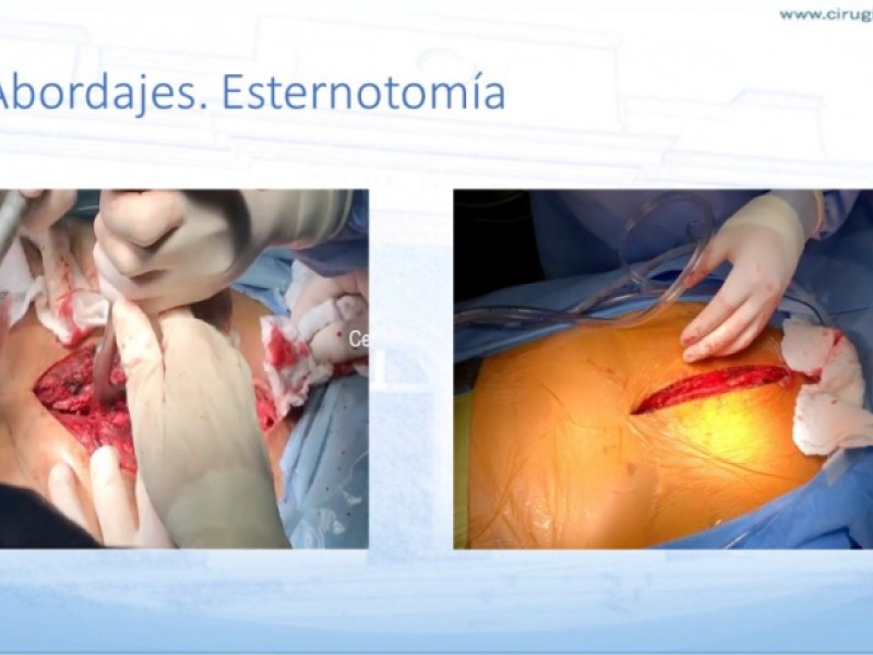 Diapositiva 18 de Trauma penetrante cardíaco