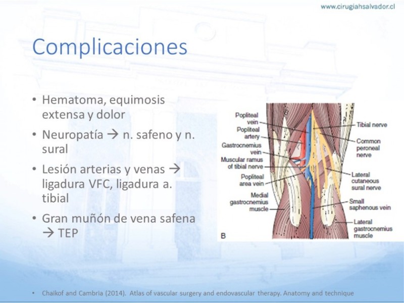 Diapositiva 13 de Safenectomía: Técnica y resultados a largo plazo