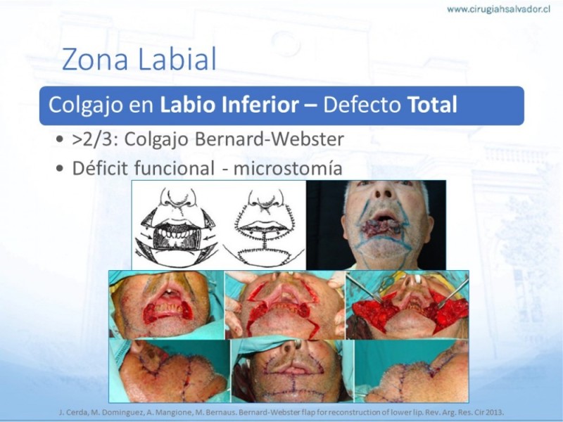 Diapositiva 43 de Tipos de Reconstrucción Facial