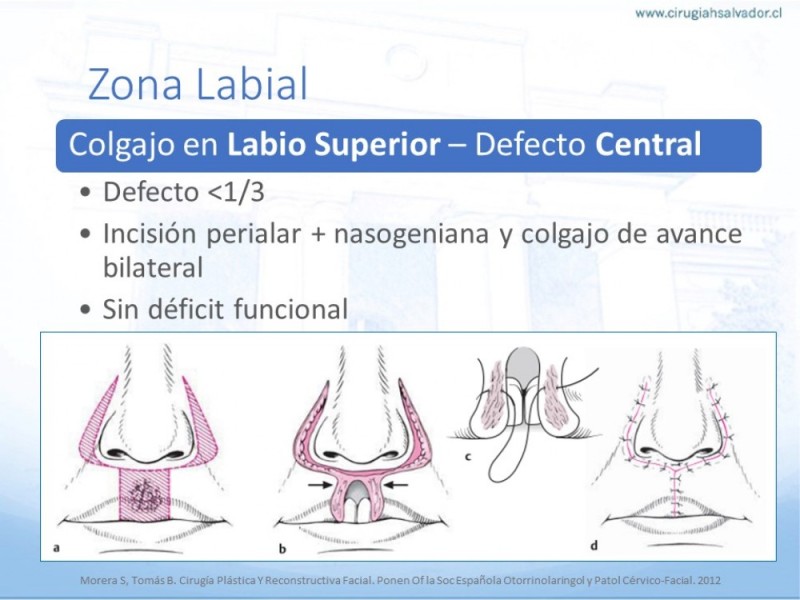 Diapositiva 37 de Tipos de Reconstrucción Facial