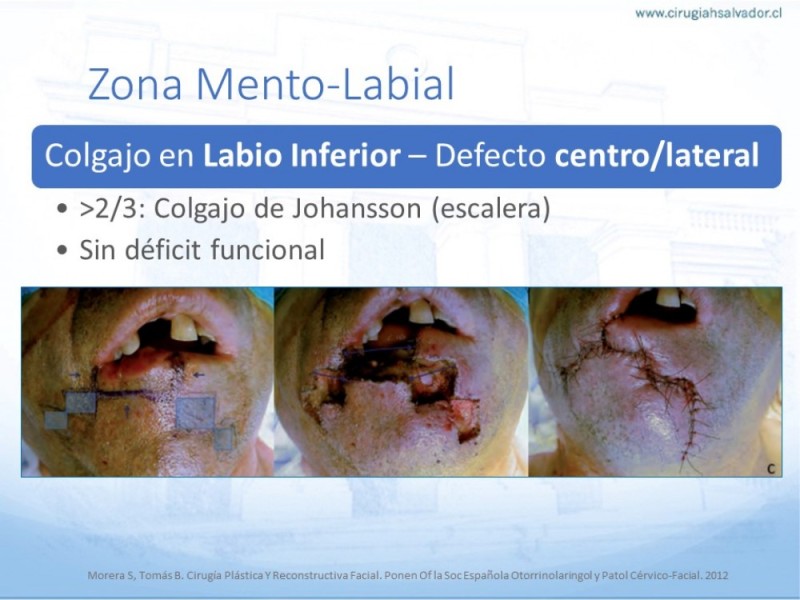 Diapositiva 44 de Tipos de Reconstrucción Facial
