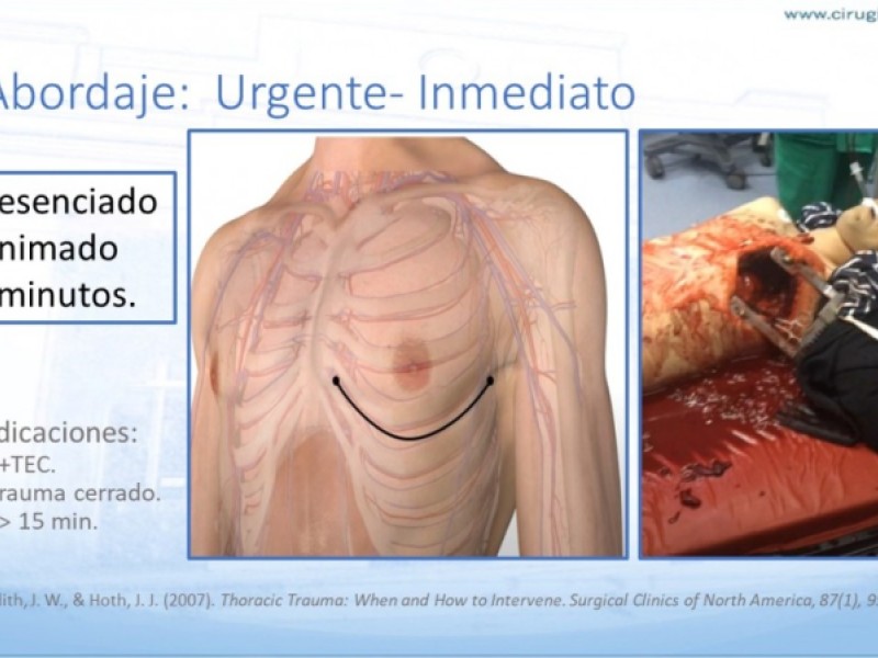 Diapositiva 15 de Trauma penetrante cardíaco