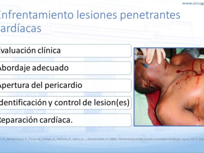 Diapositiva 7 de Trauma penetrante cardíaco