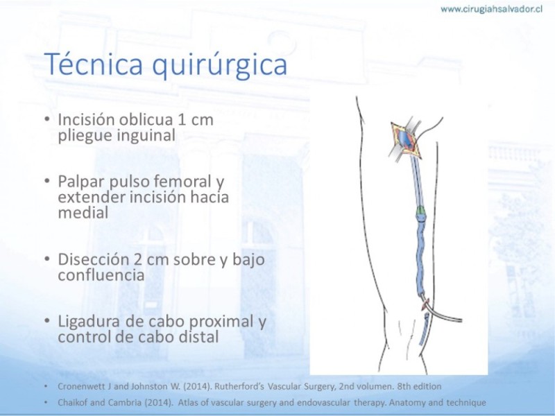 Diapositiva 9 de Safenectomía: Técnica y resultados a largo plazo