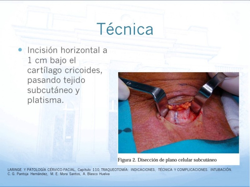 Diapositiva 13 de Traqueotomía: Indicaciones y técnica