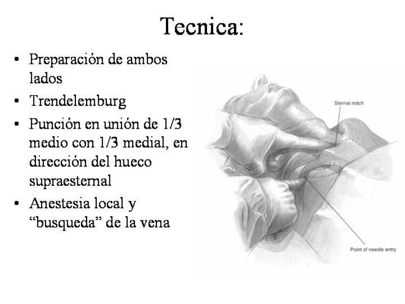 Diapositiva 9 de Catéter de Quimioterapia