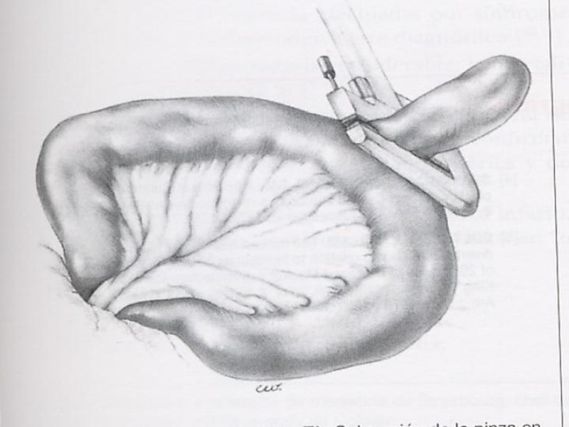 Diapositiva 31 de Divertículo de Meckel
