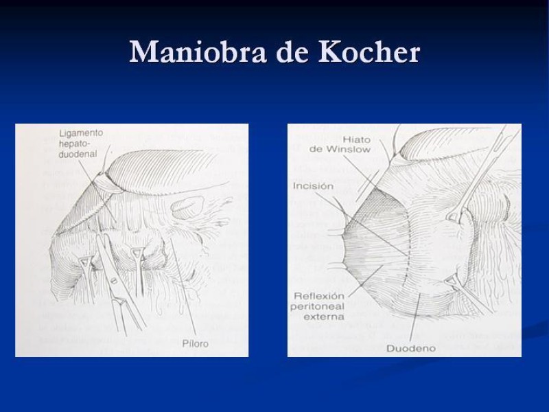 Diapositiva 22 de Trauma Pancreato-duodenal