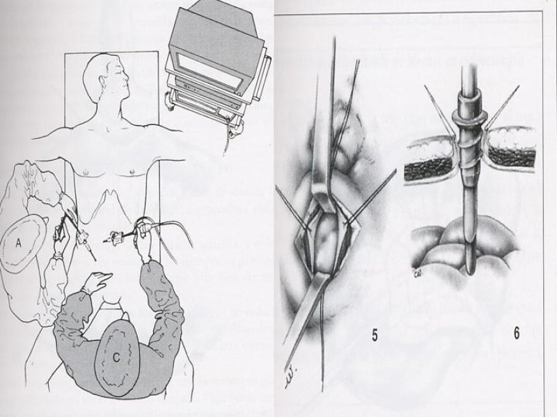 Diapositiva 21 de Divertículo de Meckel
