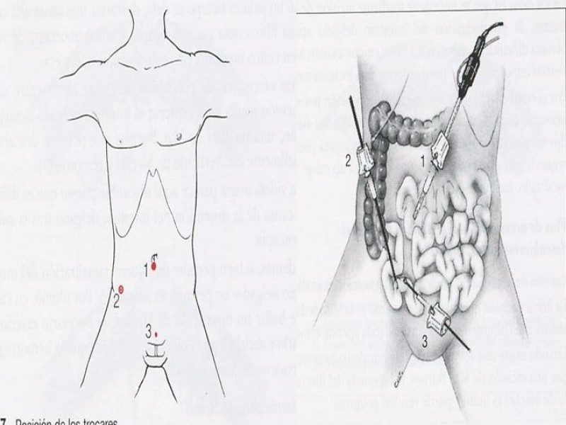 Diapositiva 22 de Divertículo de Meckel
