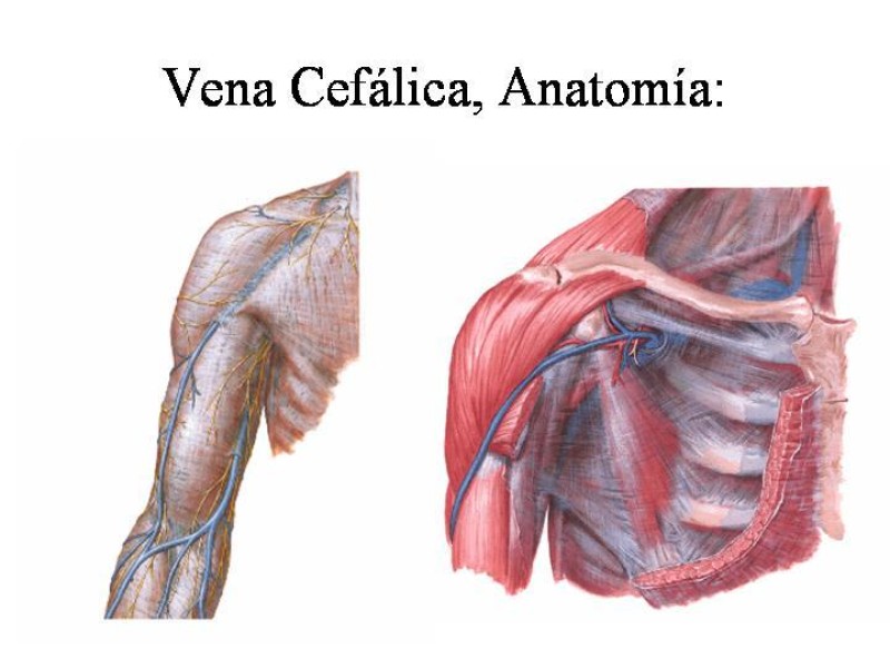 Diapositiva 4 de Catéter de Quimioterapia